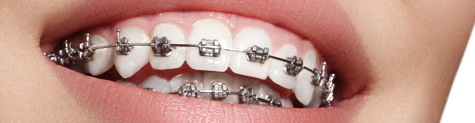 Hands holding mouth model wearing braces.